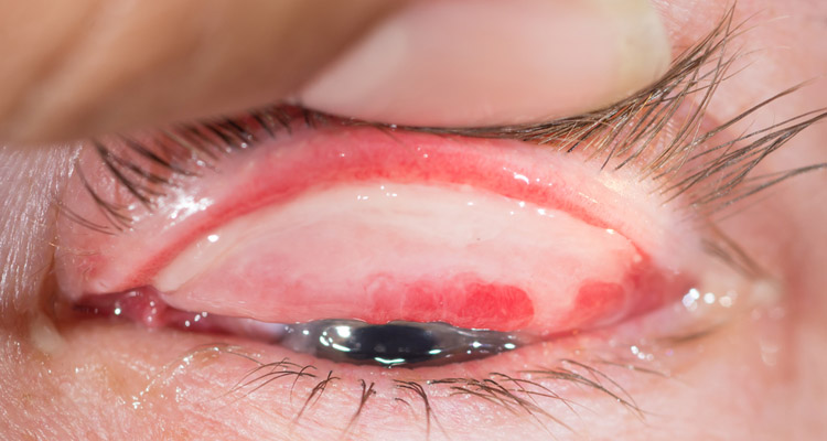 Congenital Ocular Defects