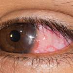 Corneal Infection and Other Causes of Red Eye