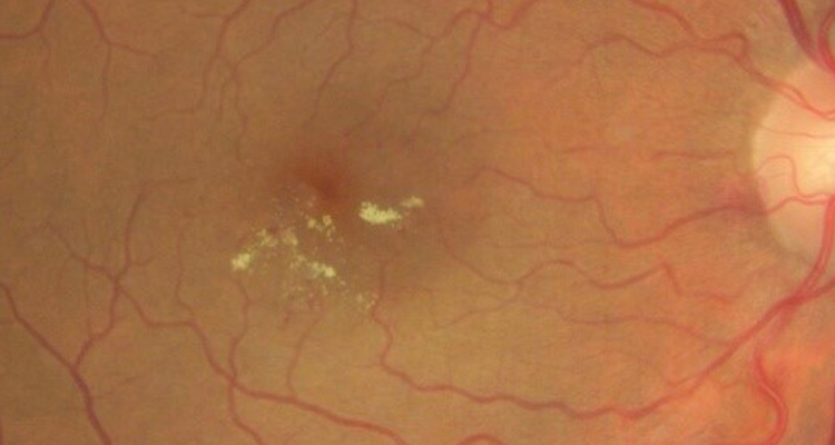 Diabetic Retinopathy Screening and Management