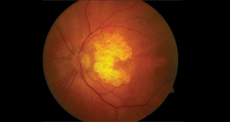 Age Related Macular Degeneration
