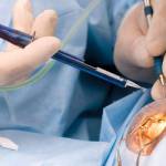 Post-operative Cataract Surgery Care