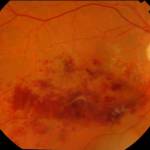 Central Retinal Vein Occlusion