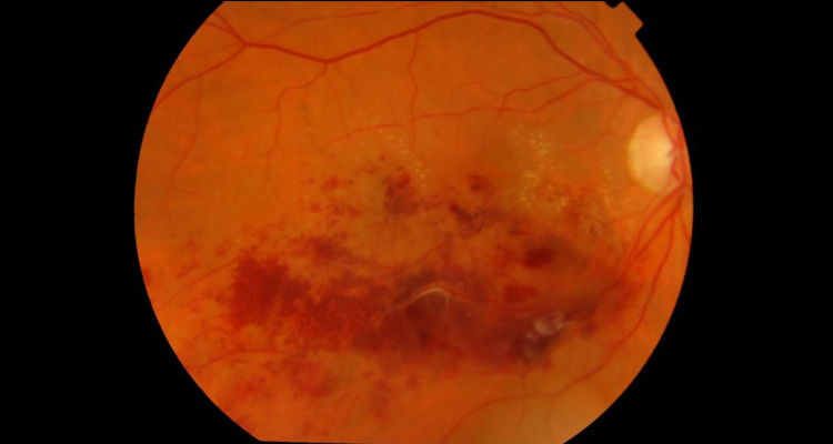 Central Retinal Vein Occlusion