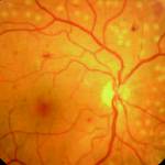 Treatment of the Diabetic Retinopathy