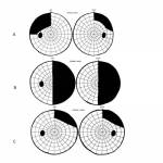Visual Field Defects